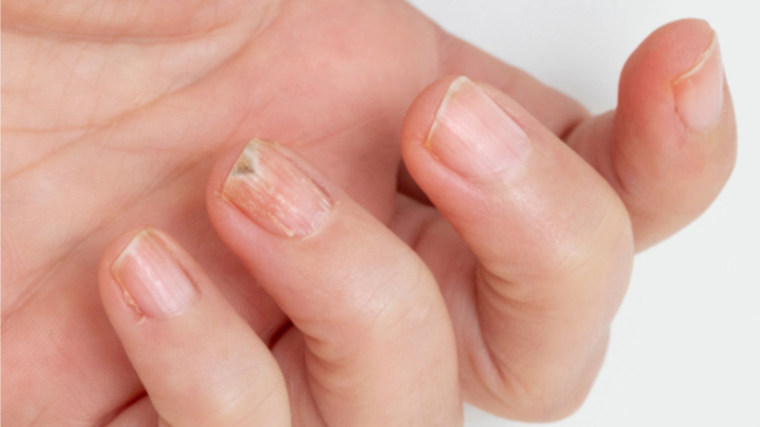 Close-up of a hand with nail fungus infection