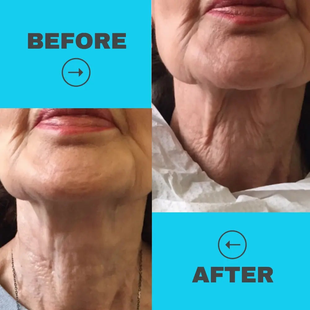 best non surgical facelift